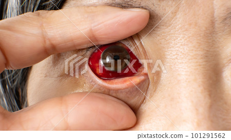 Bloodshot eyes up one eye 101291562