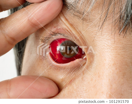 充血的眼睛向上一隻眼睛 101291570