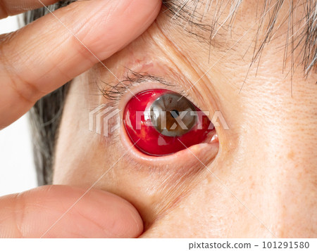 Bloodshot eyes up one eye 101291580
