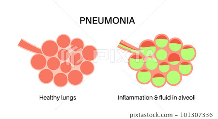 Pneumonia infection poster Pneumonia infection poster 101307336