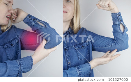 Before and after. In left woman suffers from pain in her shoulder, biceps, triceps, sprain, inflammation of the tendons. On the right, there are no problems. Showing treatment and recovery Before and after. In left woman suffers from pain in her shoulder, biceps, triceps, sprain, inflammation of the tendons. On the right, there are no problems. Showing treatment and recovery 101327000