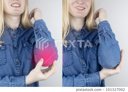 Before and after. Elbow pain. Girl shows consequences of tennis injury, overexertion, bone fractures, consequences of blow, microtrauma or arthritis. On right girl shows no more inflammation and pain 101327002