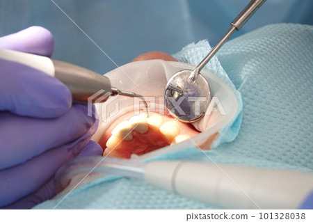Kiev, Ukraine August 22, 2020: Dentist doctor works with a patient close-up 101328038