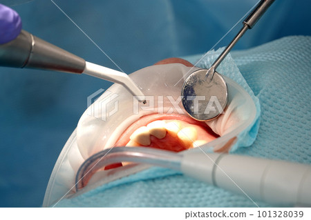 Kiev, Ukraine August 22, 2020: Dentist doctor works with a patient close-up Kiev, Ukraine August 22, 2020: Dentist doctor works with a patient close-up 101328039