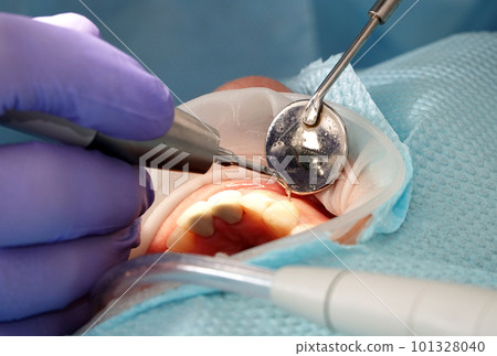 Kiev, Ukraine August 22, 2020: Dentist doctor works with a patient close-up 101328040