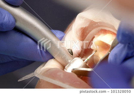 Kiev, Ukraine August 22, 2020: Dentist doctor works with a patient close-up Kiev, Ukraine August 22, 2020: Dentist doctor works with a patient close-up 101328050