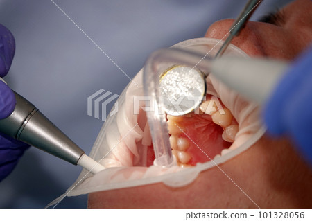 Kiev, Ukraine August 22, 2020: Dentist doctor works with a patient close-up 101328056