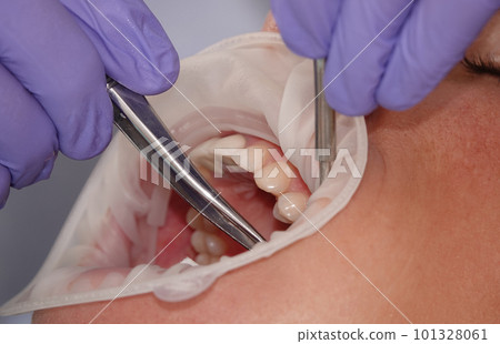 Kiev, Ukraine August 22, 2020: Dentist doctor works with a patient close-up 101328061