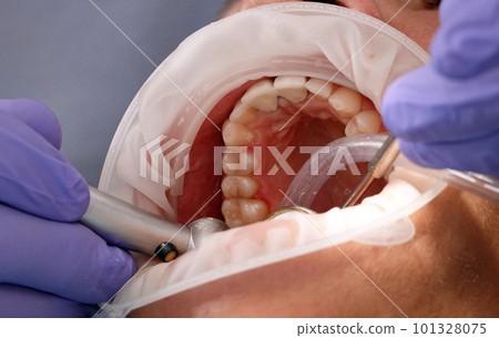Kiev, Ukraine August 22, 2020: Dentist doctor works with a patient close-up Kiev, Ukraine August 22, 2020: Dentist doctor works with a patient close-up 101328075