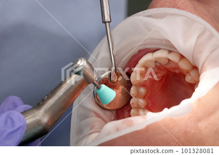 Kiev, Ukraine August 22, 2020: Dentist doctor works with a patient close-up Kiev, Ukraine August 22, 2020: Dentist doctor works with a patient close-up 101328081