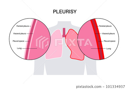 Pleurisy inflammation diseases 101334937