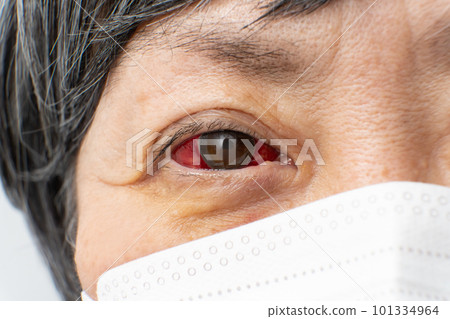 充血性結膜炎眼罩 101334964