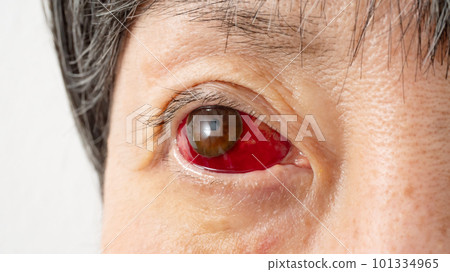 Hyperemia conjunctivitis eye Hyperemia conjunctivitis eye 101334965