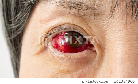 Hyperemia conjunctivitis eye Hyperemia conjunctivitis eye 101334966