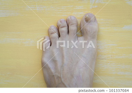 Toenails with fungus problems on yellow background close up 101337084