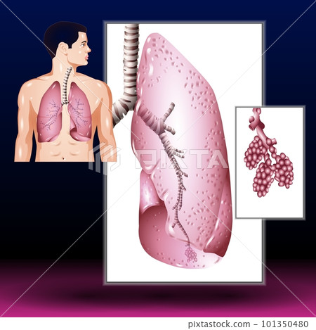 Man with Lungs Man with Lungs 101350480