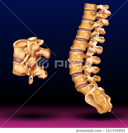 Spinal Stenosis medical concept as a degenerative illness in the human vertebrae Spinal Stenosis medical concept as a degenerative illness in the human vertebrae 101350993