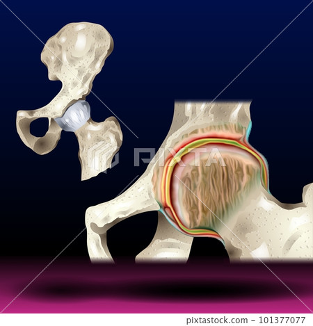 Septic Arthritis Hip - Knee joint with arthritis ( Gout , Rheumatoid arthritis , Septic arthritis ) Septic Arthritis Hip - Knee joint with arthritis ( Gout , Rheumatoid arthritis , Septic arthritis ) 101377077