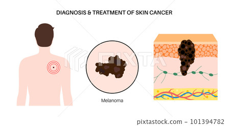 Skin cancer diagnosis 101394782