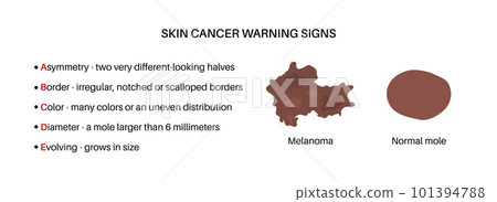 Melanoma warning signs 101394788