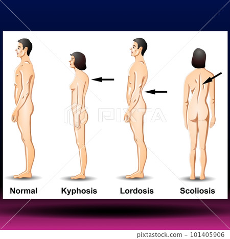 Spine Curves - Spinal deformity. Symbol of spine curvatures or unhealthy backbones. Human spine anatomy, curved spine. 101405906