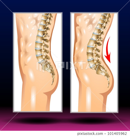 Spine Curves - Spinal deformity. Symbol of spine curvatures or unhealthy backbones. Human spine anatomy, curved spine. 101405962