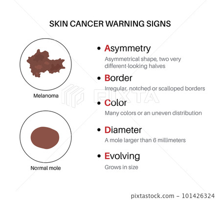 Melanoma warning signs Melanoma warning signs 101426324