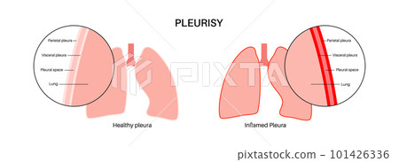 Pleurisy inflammation diseases 101426336