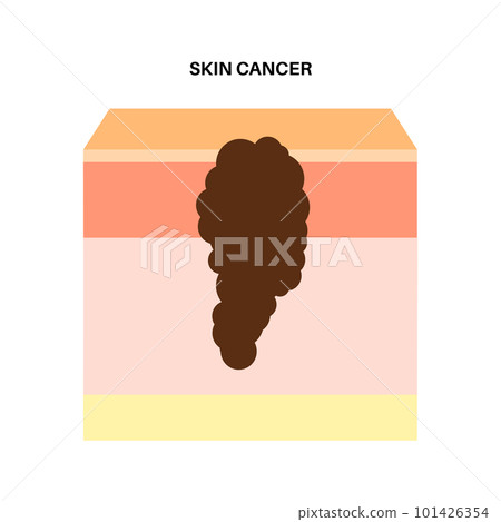 Skin cancer anatomy 101426354