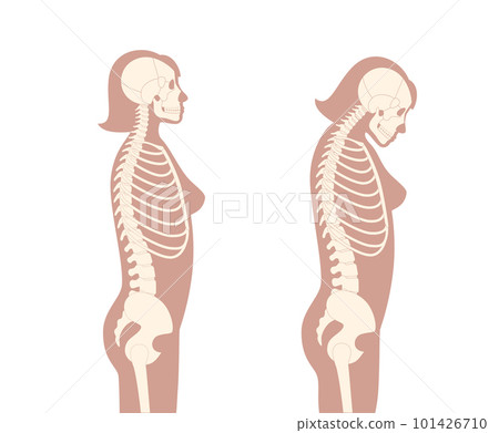 Neck vertebrae deformity 101426710