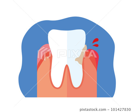 swollen bleeding gums 101427830