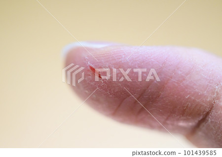 指尖乾裂 指尖乾裂 101439585