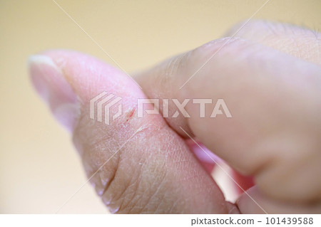 chapped fingertips chapped fingertips 101439588