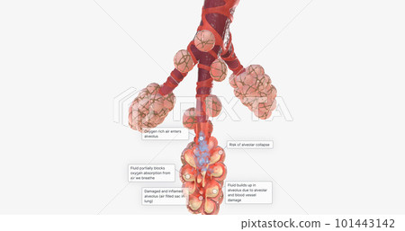 COVID-19, Acute Respiratory Distress Syndrome 101443142