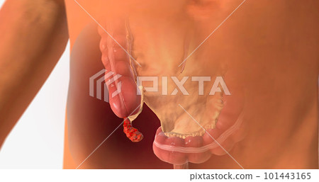 It is characterized by appendicitis, bacterial infection, stagnation of waste materials, parasites, inflammatory bowel disease. It is characterized by appendicitis, bacterial infection, stagnation of waste materials, parasites, inflammatory bowel disease. 101443165