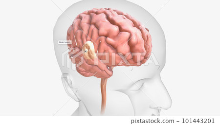 Brain tumors are abnormal growths found in brain tissue. Brain tumors may be benign or malignant. Brain tumors are abnormal growths found in brain tissue. Brain tumors may be benign or malignant. 101443201
