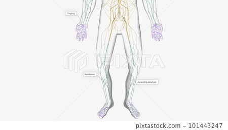 Guillain Barre syndrome is a rare disorder in which your body's immune system attacks your nerves. 101443247