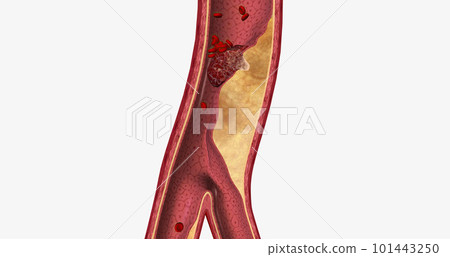 Atherosclerosis is a cardiovascular disease characterized by the gradual buildup of plaque in artery walls. 101443250