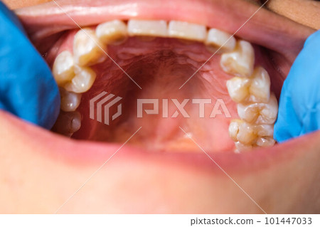 Close-up of the upper jaw, hard palate, soft palate, teeth and gums of a middle-aged woman. 101447033