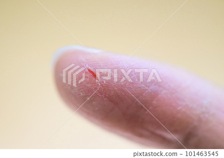 chapped fingertips chapped fingertips 101463545