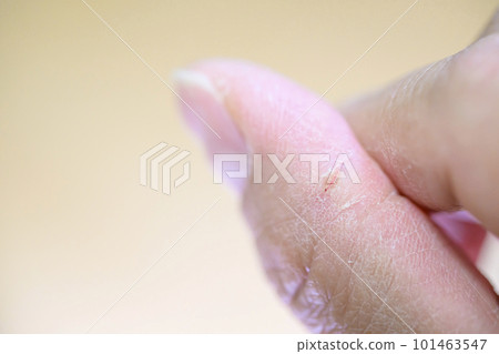 chapped fingertips chapped fingertips 101463547