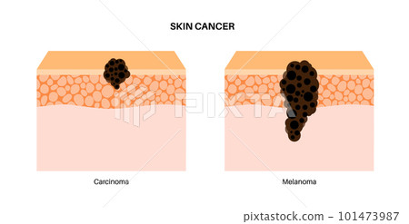 Melanoma and carcinoma 101473987