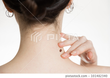 Dermatology. Close-up of a woman's neck. The hand shows a large mole. The concept of checking moles for malignancy 101482340