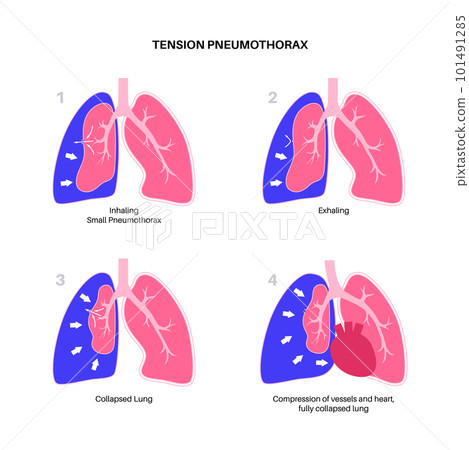 Tension pneumothorax poster Tension pneumothorax poster 101491285