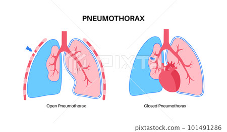 Pneumothorax anatomical poster 101491286