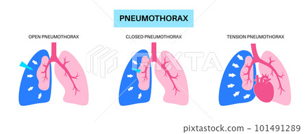 Pneumothorax anatomical poster 101491289