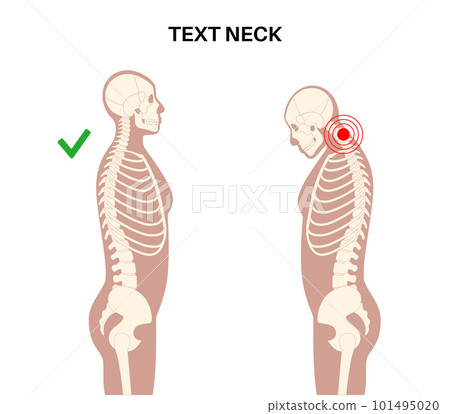 Neck vertebrae deformity 101495020