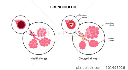 Bronchiolitis lung disease Bronchiolitis lung disease 101495026