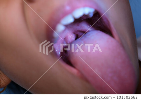 Close-up inside the oral cavity of a healthy child with beautiful rows of baby teeth. Young girl opens mouth revealing upper and lower teeth, hard palate, soft palate, dental and oral health checkup. Close-up inside the oral cavity of a healthy child with beautiful rows of baby teeth. Young girl opens mouth revealing upper and lower teeth, hard palate, soft palate, dental and oral health checkup. 101502662