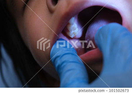 Close-up inside the oral cavity of a healthy child with beautiful rows of baby teeth. Young girl opens mouth revealing upper and lower teeth, hard palate, soft palate, dental and oral health checkup. 101502673